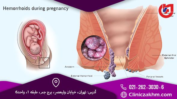 درمان بواسیر در بارداری