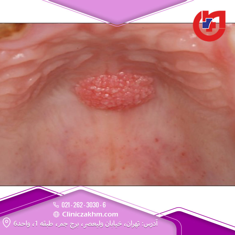 زگیل دهانی چیست؟ عوامل خطر، تشخیص و درمان HPV در دهان