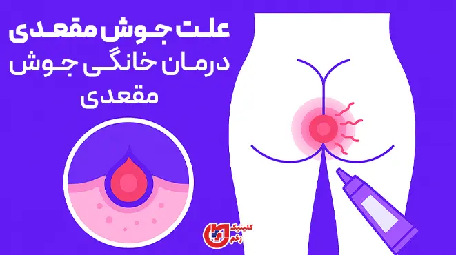 اینفوگرافیک علت جوش‌های نشیمنگاه و اطراف مقعد: تحریک پوستی، تعریق، موهای زیرپوستی، فولیکولیت، اصطکاک و بهداشت ناکافی