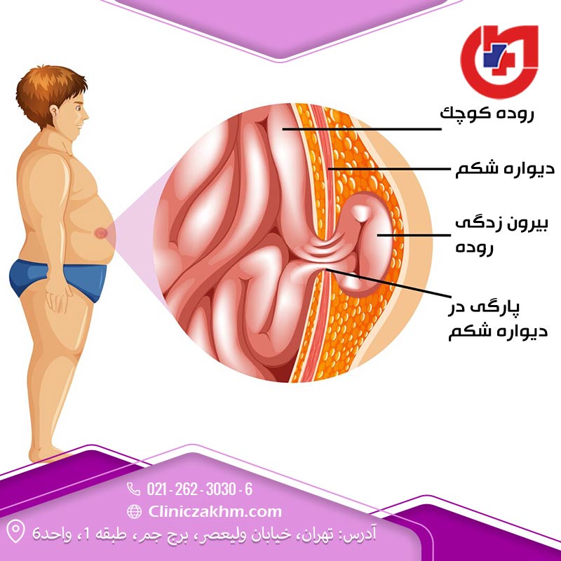 فتق یا باد فتق چیست