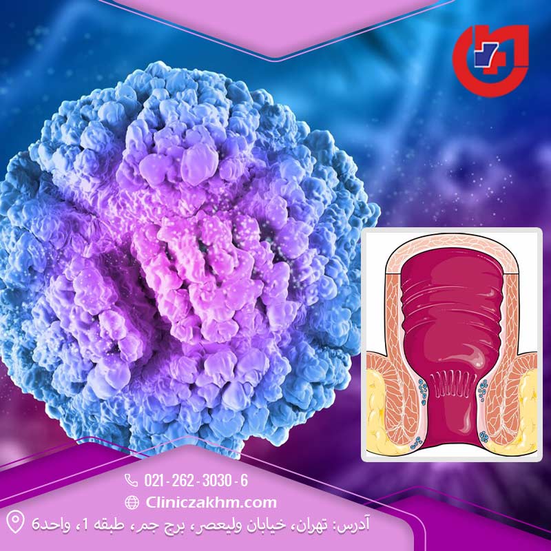علائم سرطان مقعد و چگونگی تشخیص