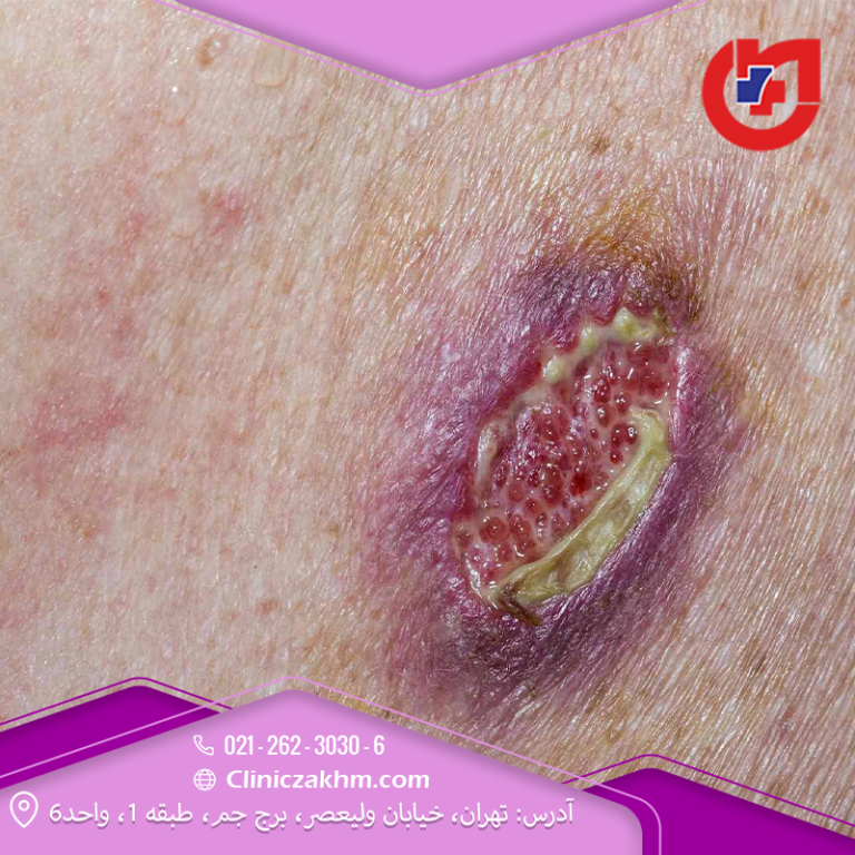 جداسازی و بیرون زدگی زخم جراحی: چه باید کرد؟