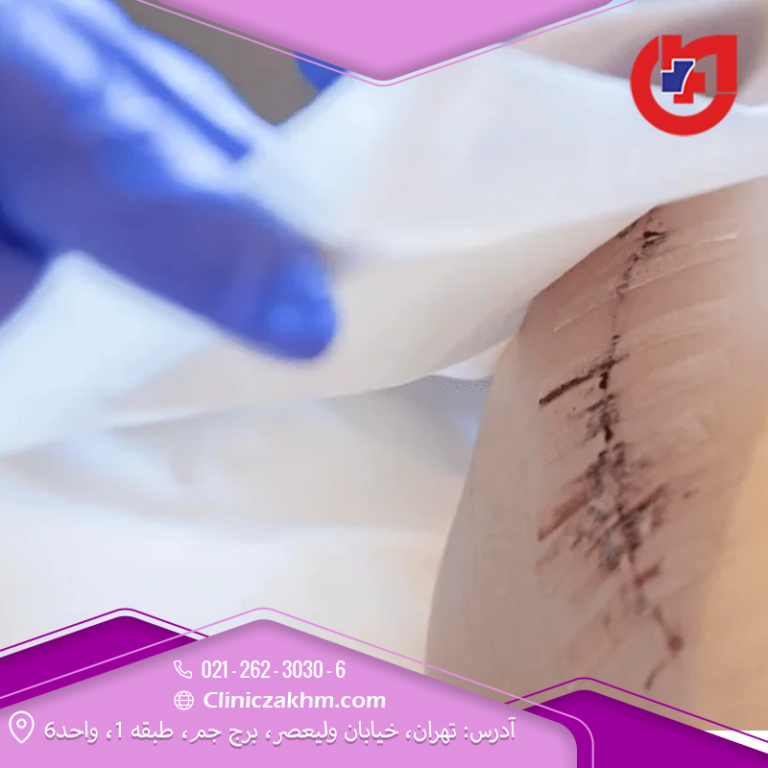 چگونه از درن جراحی خود در خانه مراقبت کنیم؟