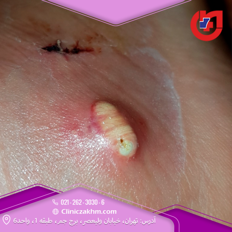 وجود چرک پس از عمل جراحی