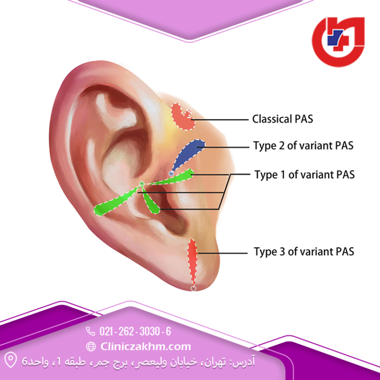 سوراخ در گوش (گودال Preauricular)