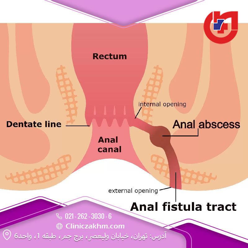 عوارض فیستول مقعدی یا آنال چیست؟