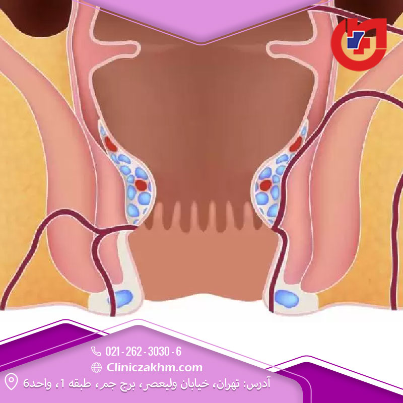 آبسه و فیستول مقعدی 