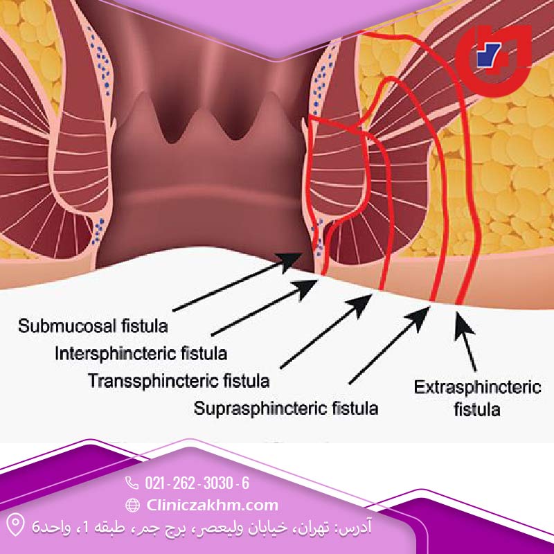 انواع فیستول مقعدی چیست؟