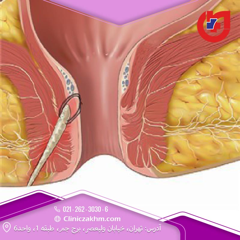 انواع مختلف فیستول مقعدی