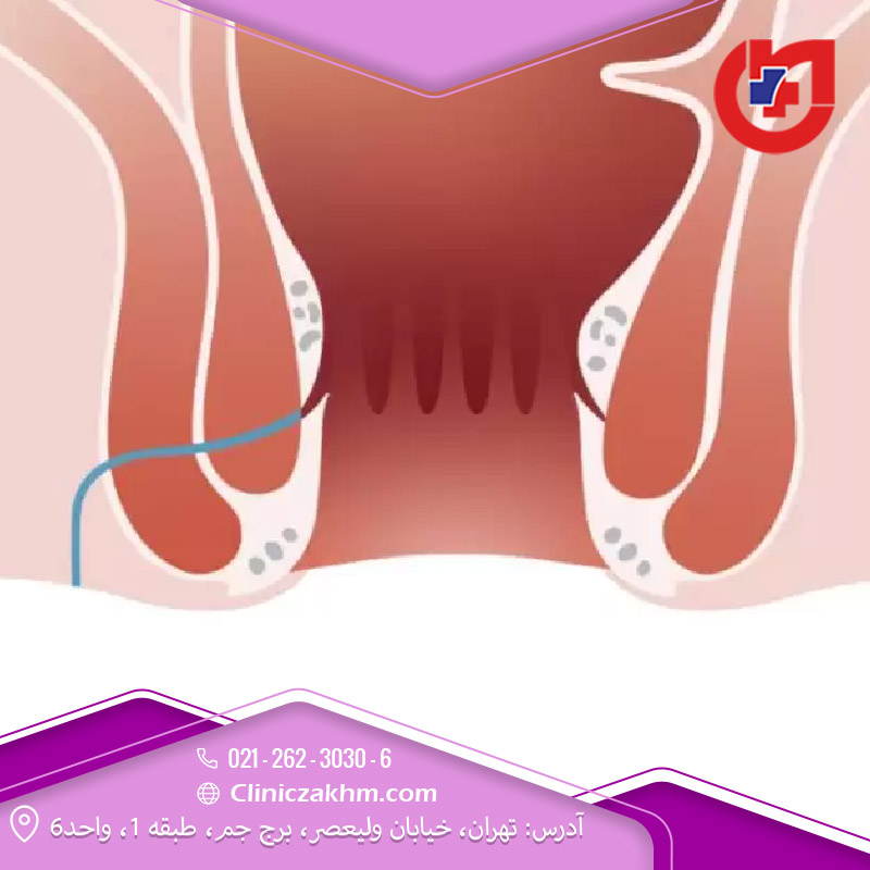 جلوگیری از فیستول مقعدی 