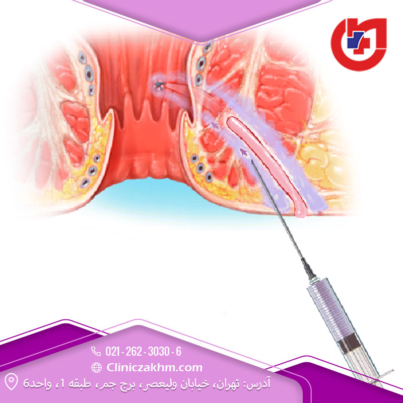 روش‌های درمان فیستول مقعدی