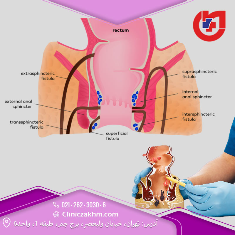 ظاهر فیستول مقعدی