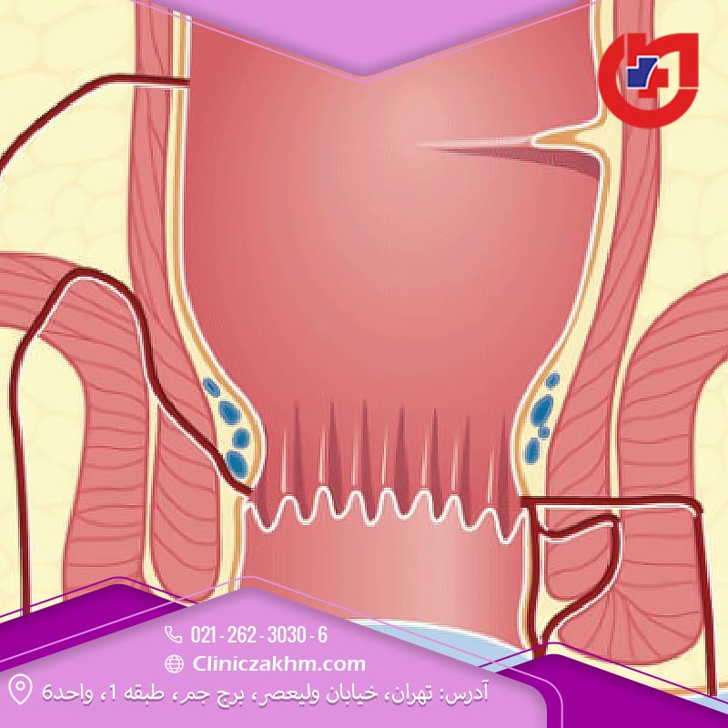 علائم فیستول مقعدی در مردان