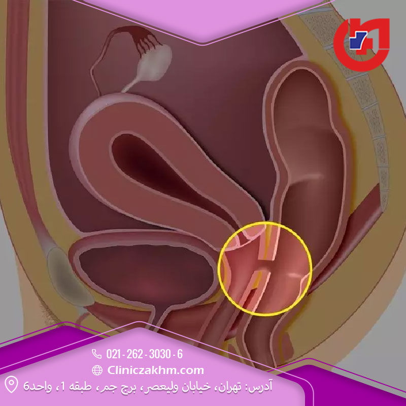 علت فیستول مقعدی در زنان
