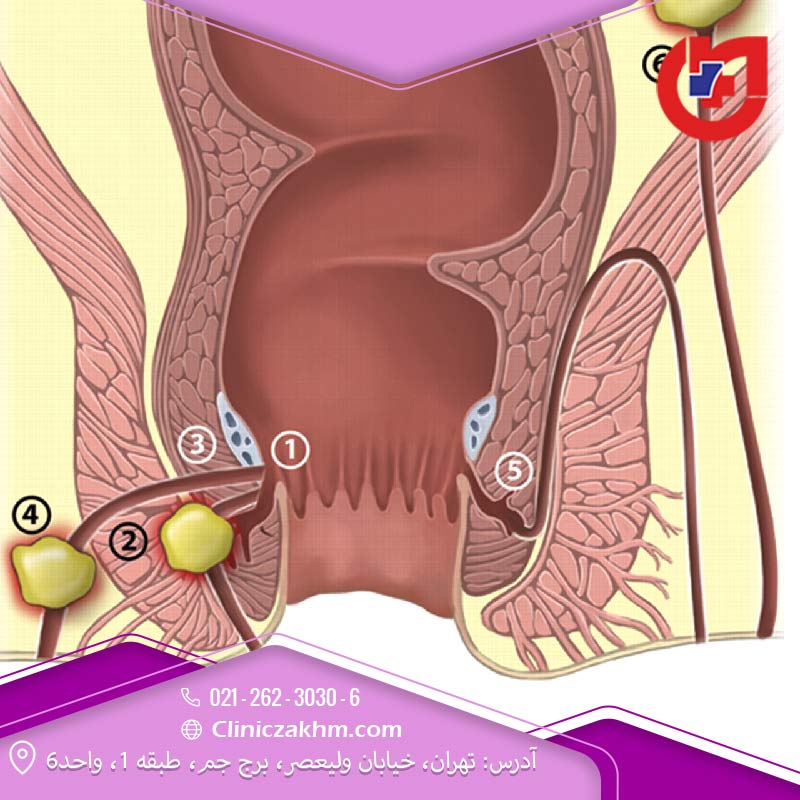 محل قرارگیری انواع فیستول مقعدی 