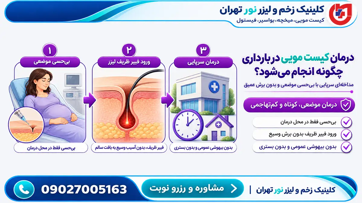 تخلیه و درمان کمتهاجمی کیست مویی با بیحسی موضعی بدون بیهوشی در بارداری