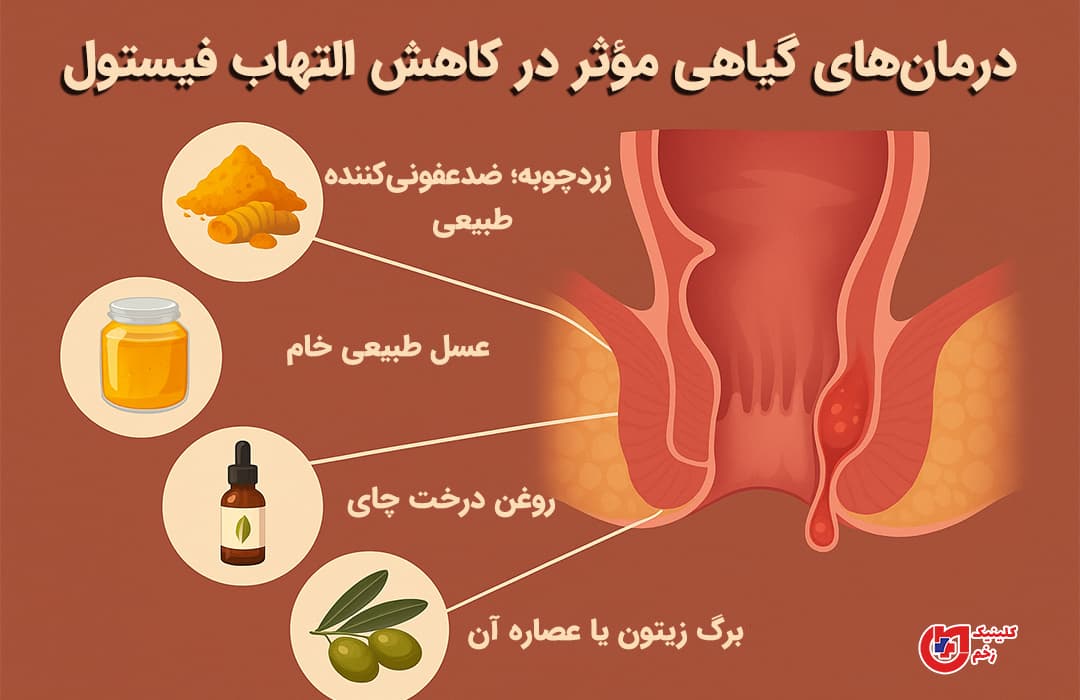  اینفوگراف فارسی درباره درمان گیاهی فیستول با نمایش زردچوبه، عسل، روغن درخت چای و برگ زیتون در کنار تصویر گرافیکی از مقعد ملتهب