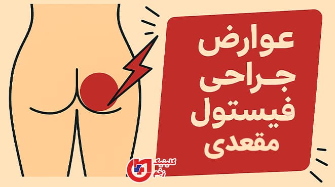 عوارض جراحی فیستول مقعدی