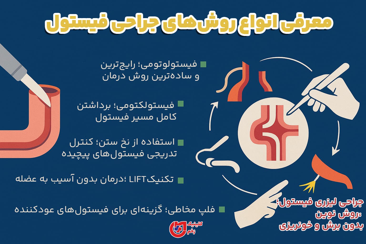 معرفی انواع روش_های جراحی فیستول