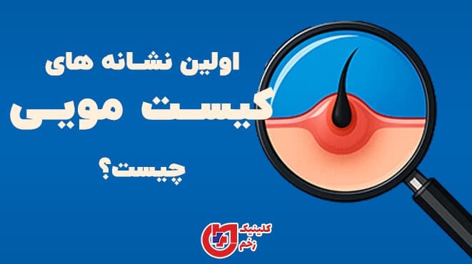 تصویر گرافیکی بزرگ‌نمایی شده از یک برجستگی مویی ملتهب با ذره‌بین، همراه با متن فارسی "اولین نشانه‌های کیست مویی چیست؟" روی زمینه آبی
