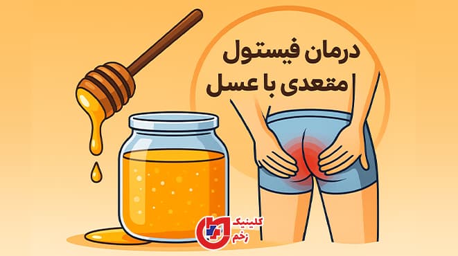 نمایی از درمان فیستول مقعدی با عسل؛ تصویر گرافیکی فرد مبتلا به درد در ناحیه مقعد همراه با عسل طبیعی و نوشته فارسی