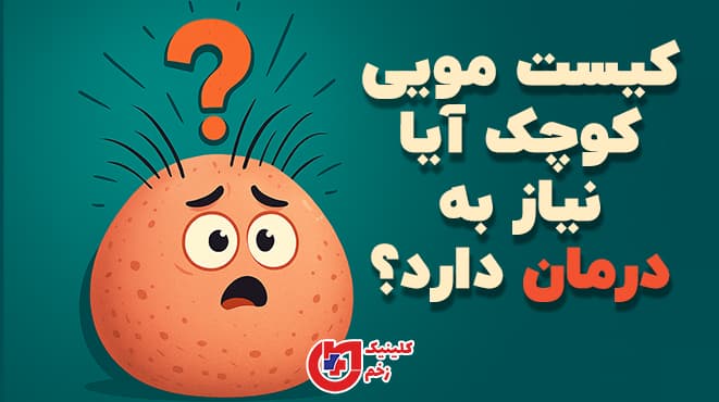 کیست مویی کوچک آیا نیاز به درمان دارد؟