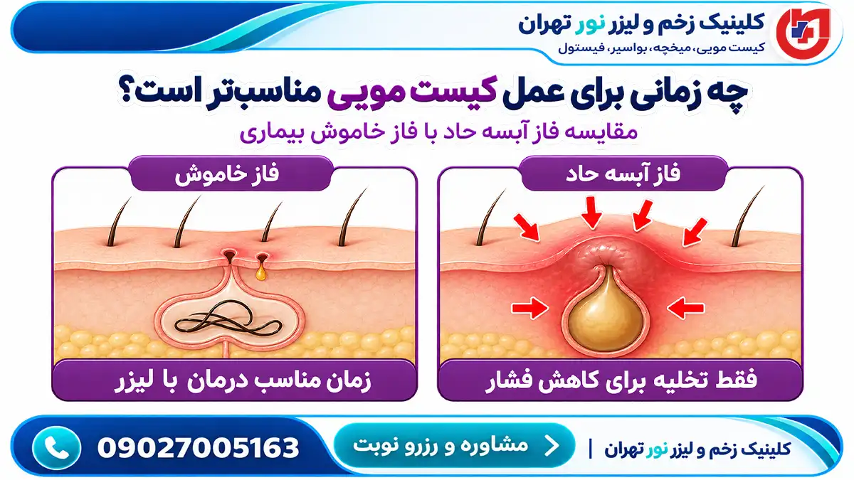 مقایسه فاز آبسه حاد و فاز خاموش کیست مویی جهت تعیین بهترین زمان عمل در کلینیک نور