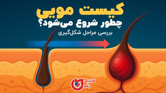 بنر افقی با پس‌زمینه گرادیانت آبی، نمای مقطعی پوست نشان‌دهنده فولیکول سالم تا کیست ملتهب و متن فارسی «کیست مویی چطور شروع می‌شود؟ بررسی مراحل شکل‌گیری».
