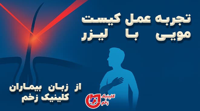 بنر مستطیل افقی با پس‌زمینه آبی و پرتو لیزر قرمز در حال درمان کیست مویی، همراه با متن فارسی «تجربه عمل کیست مویی با لیزر از زبان بیماران کلینیک زخم» و لوگوی کلینیک.