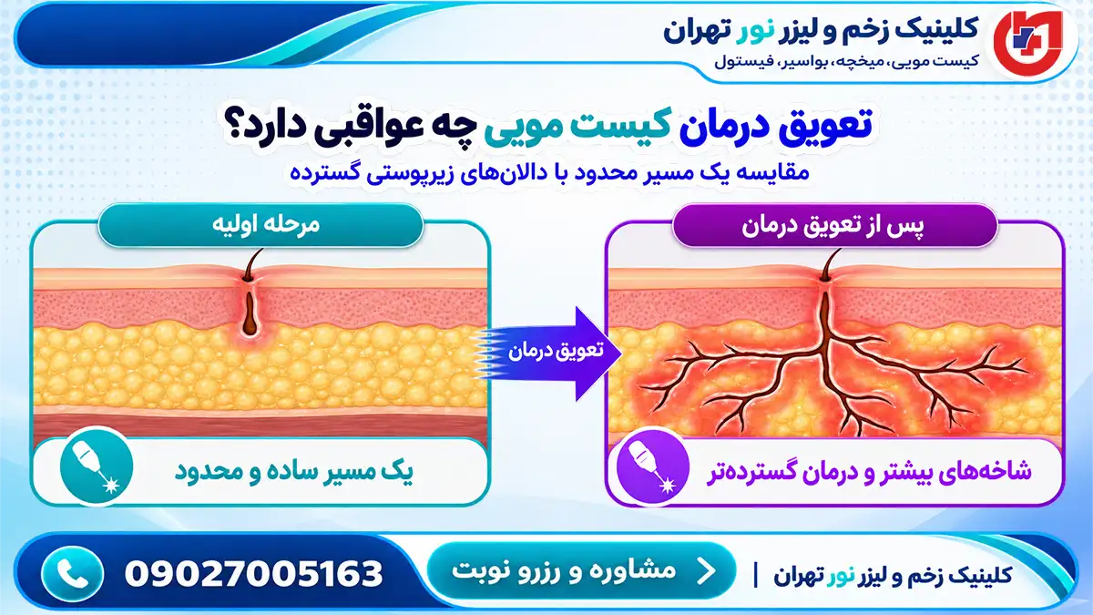 دیاگرام گسترش شاخههای زیرپوستی کیست مویی بر اثر تعویق درمان و عواقب تاخیر در عمل