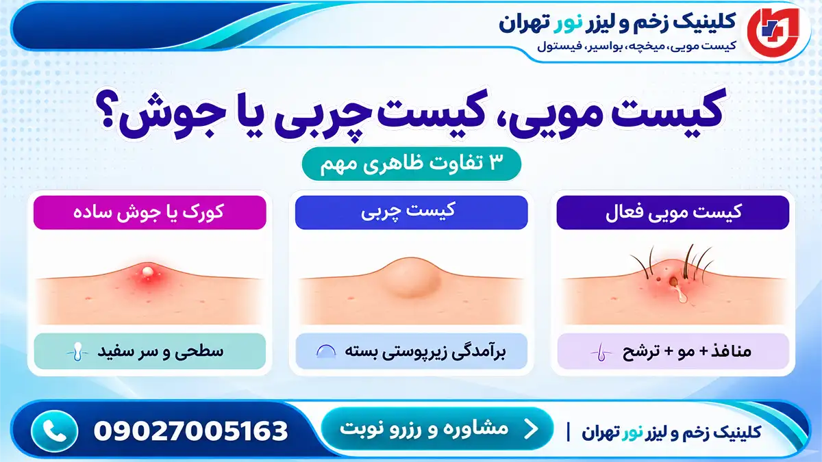 نشانه‌های هشدار کیست مویی و اهمیت مراجعه به‌موقع برای درمان