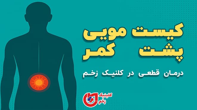 «تصویر گرافیکی پزشکی با نشان دادن ناحیه‌ی کمر و کیست مویی همراه متن درمان قطعی در کلینیک زخم»