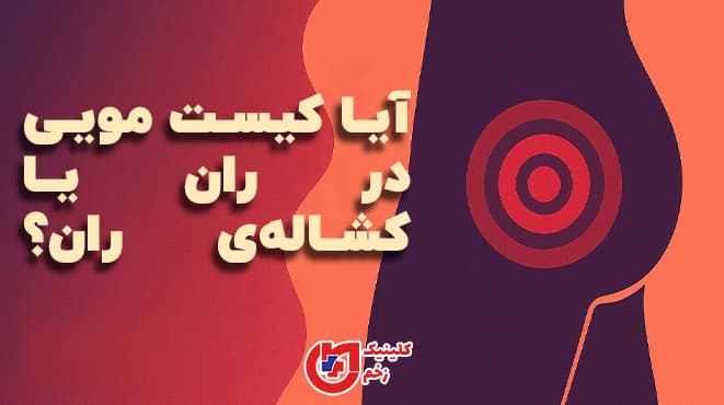 گرافیک مفهومی از سیلوئت ران انسان با نشان‌گذاری نقطه‌ی قرمز در کشاله‌ی ران و متن فارسی «کیست مویی در ران یا کشاله‌ی ران؟» بر پس‌زمینه‌ای دو رنگ