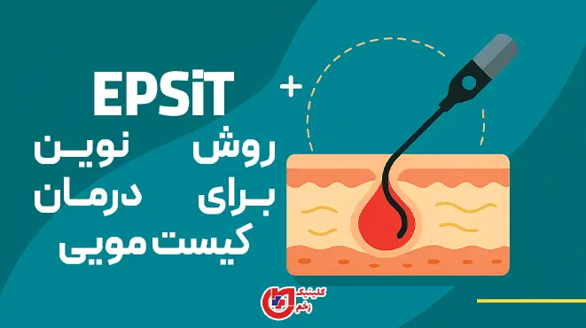 روش نوین EPSiT برای درمان کیست مویی