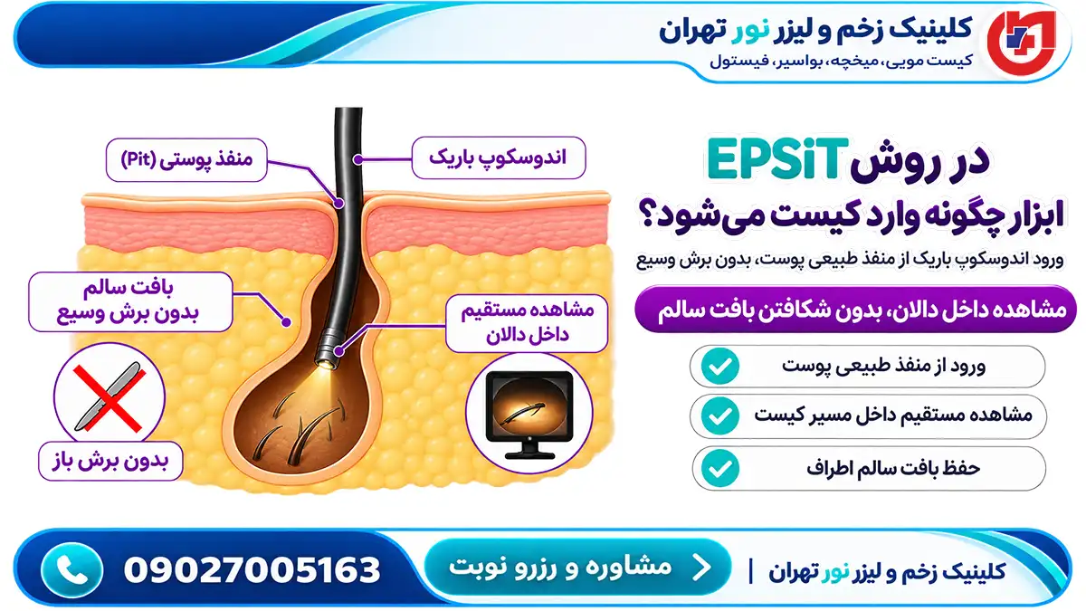 روش EPSiT برای درمان کیست مویی به روش اندوسکوپیک