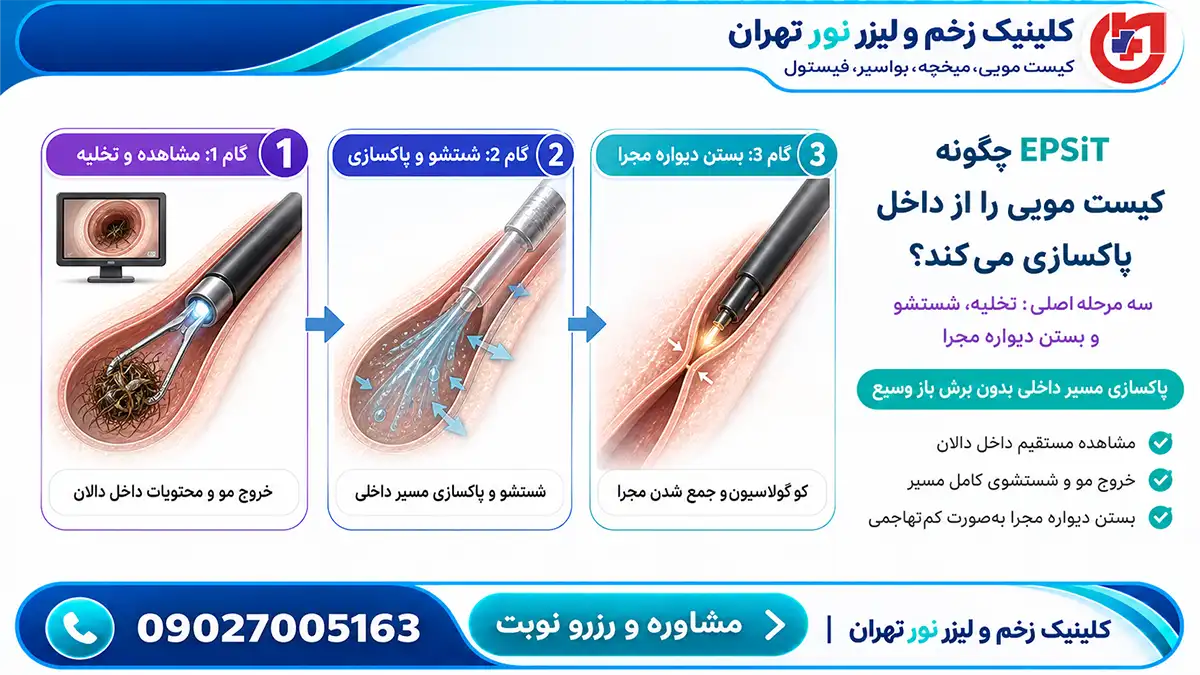مراحل انجام روش EPSiT برای درمان کیست مویی در کلینیک زخم نور