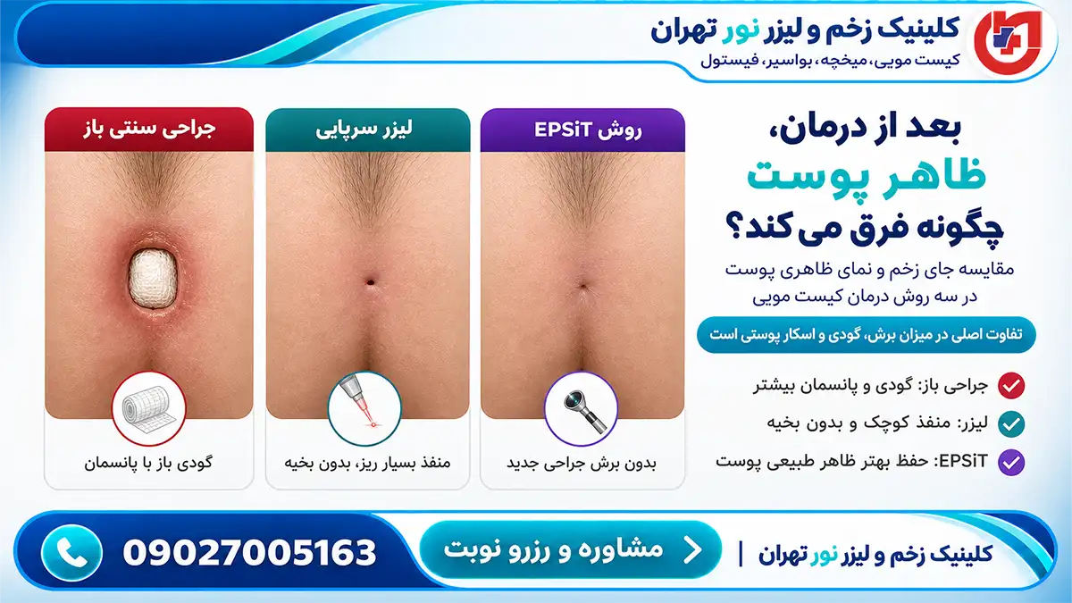 مقایسه روش EPSiT با سایر روش‌های درمان کیست مویی