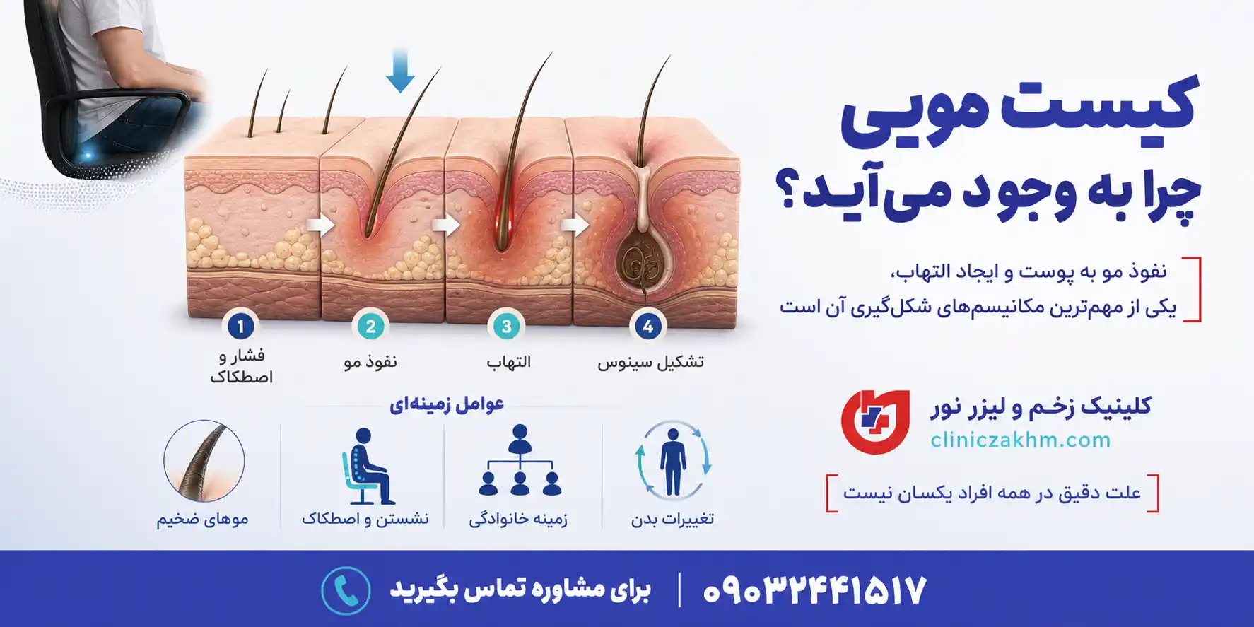علت به وجود آمدن کیست مویی در بدن و عوامل موثر در ایجاد سینوس پیلونیدال