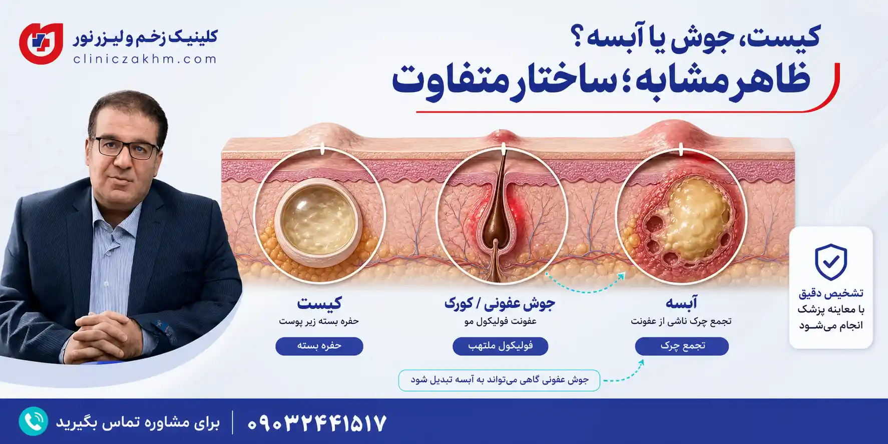 تفاوت کیست، جوش و آبس