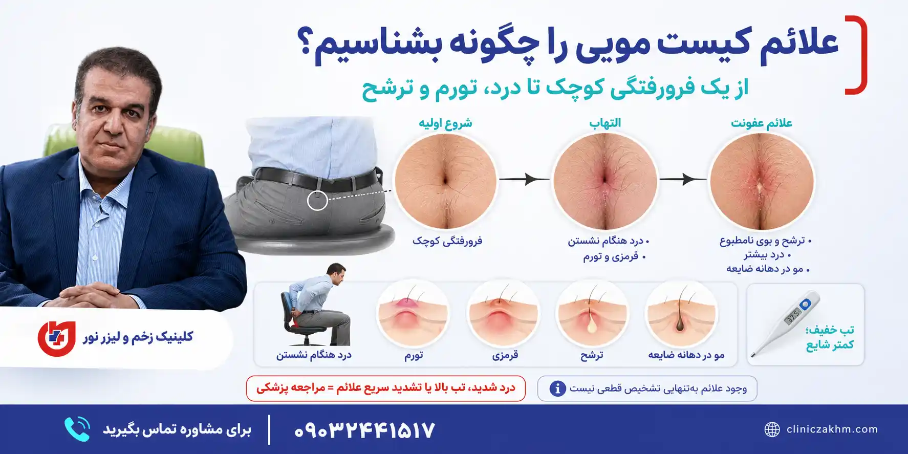 شناسایی علائم کیست مویی و نشانه های اولیه بروز سینوس پیلونیدال
