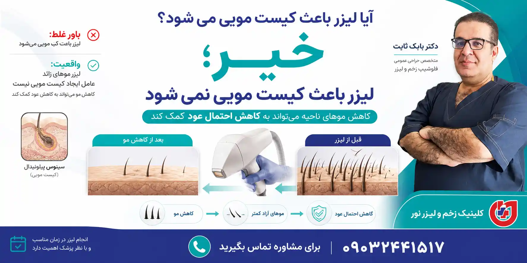 بررسی ارتباط لیزر موهای زائد با ایجاد کیست مویی و سینوس پیلونیدال