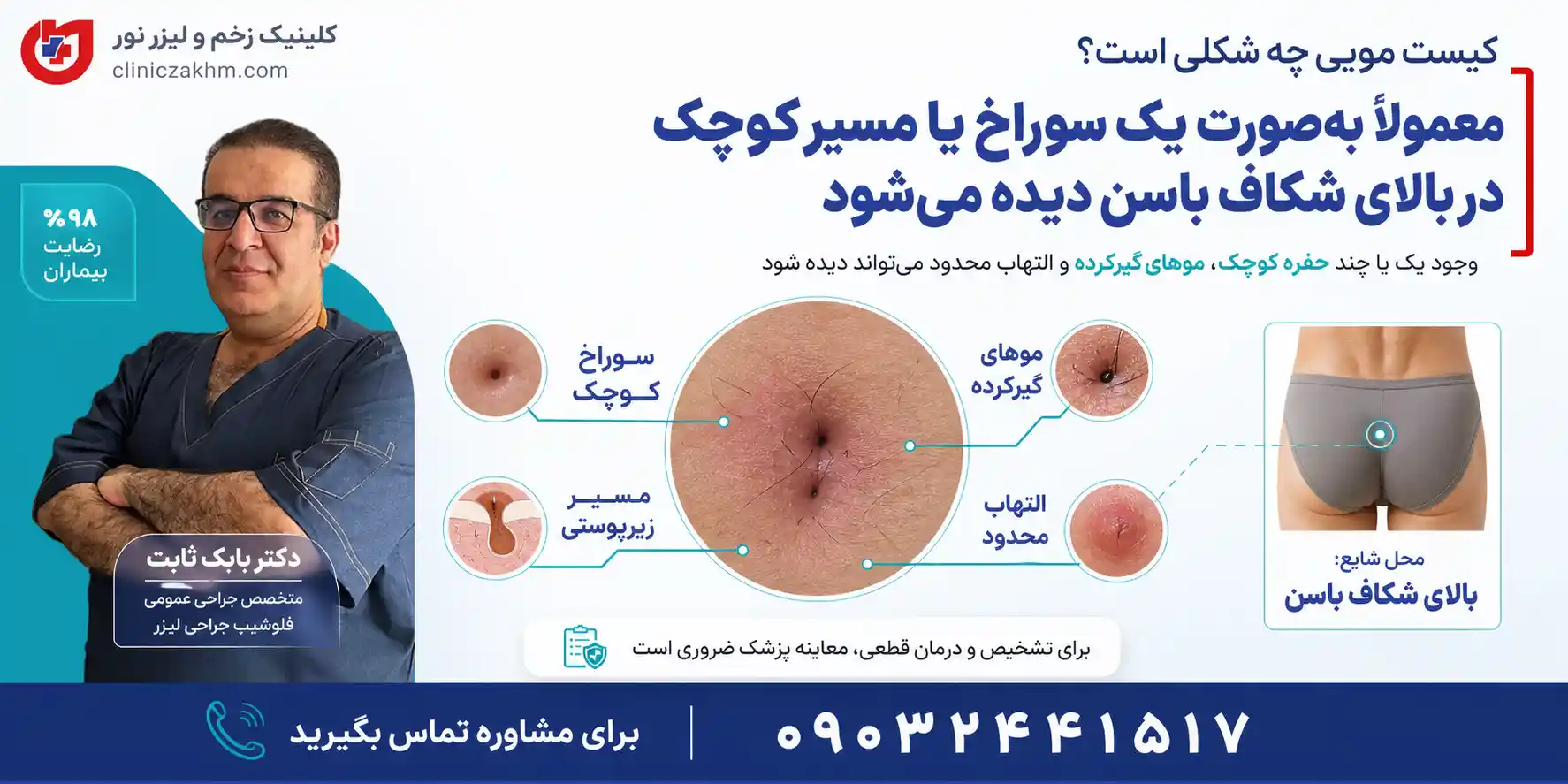 ظاهر کیست مویی و شکل سینوس پیلونیدال روی پوست