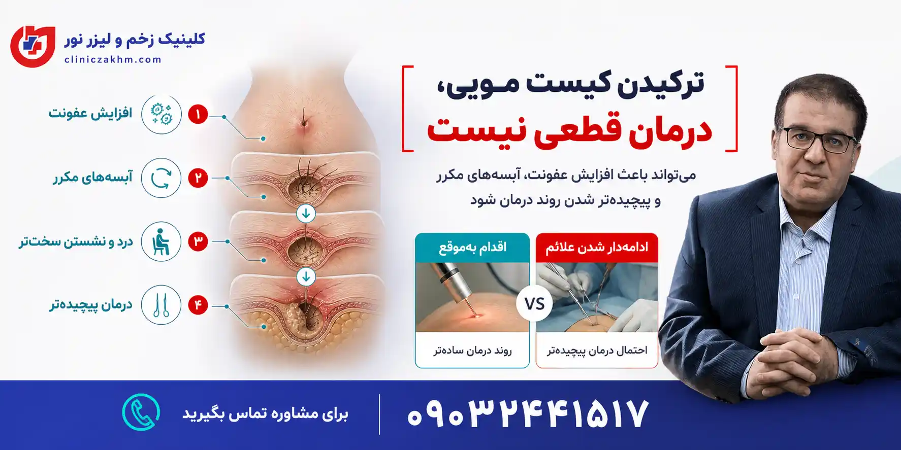 خطرات ترکیدن کیست مویی