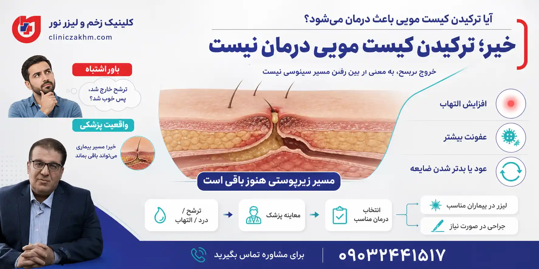 آیا ترکیدن کیست مویی باعث درمان کیست مویی می شود؟