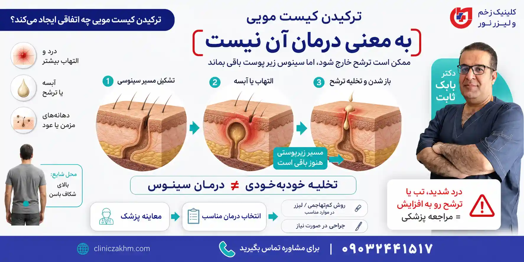 ترکیدن کیست مویی و بررسی علائم