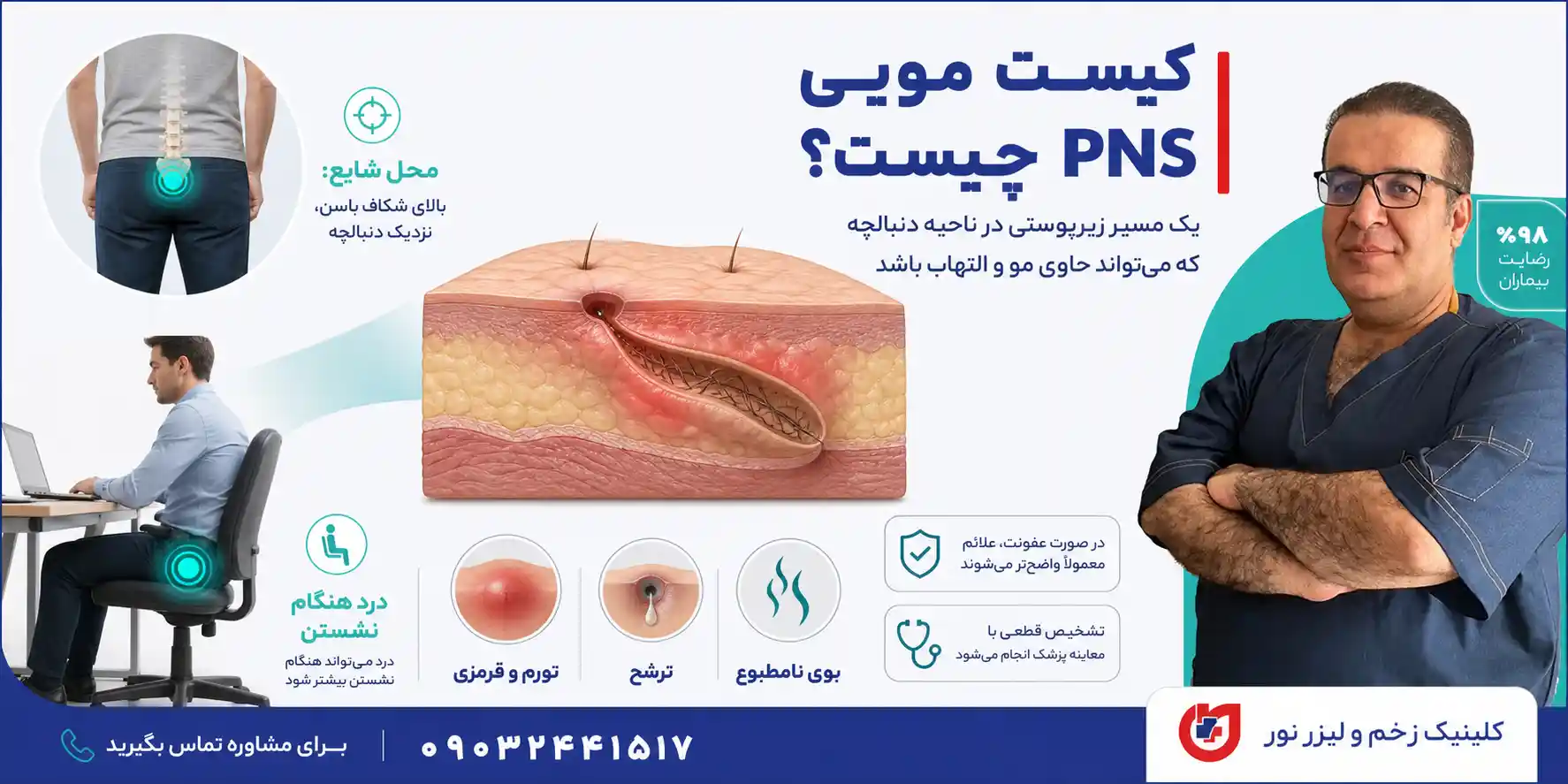 کیست مویی PNS چیست و چه ارتباطی با سینوس پیلونیدال دارد