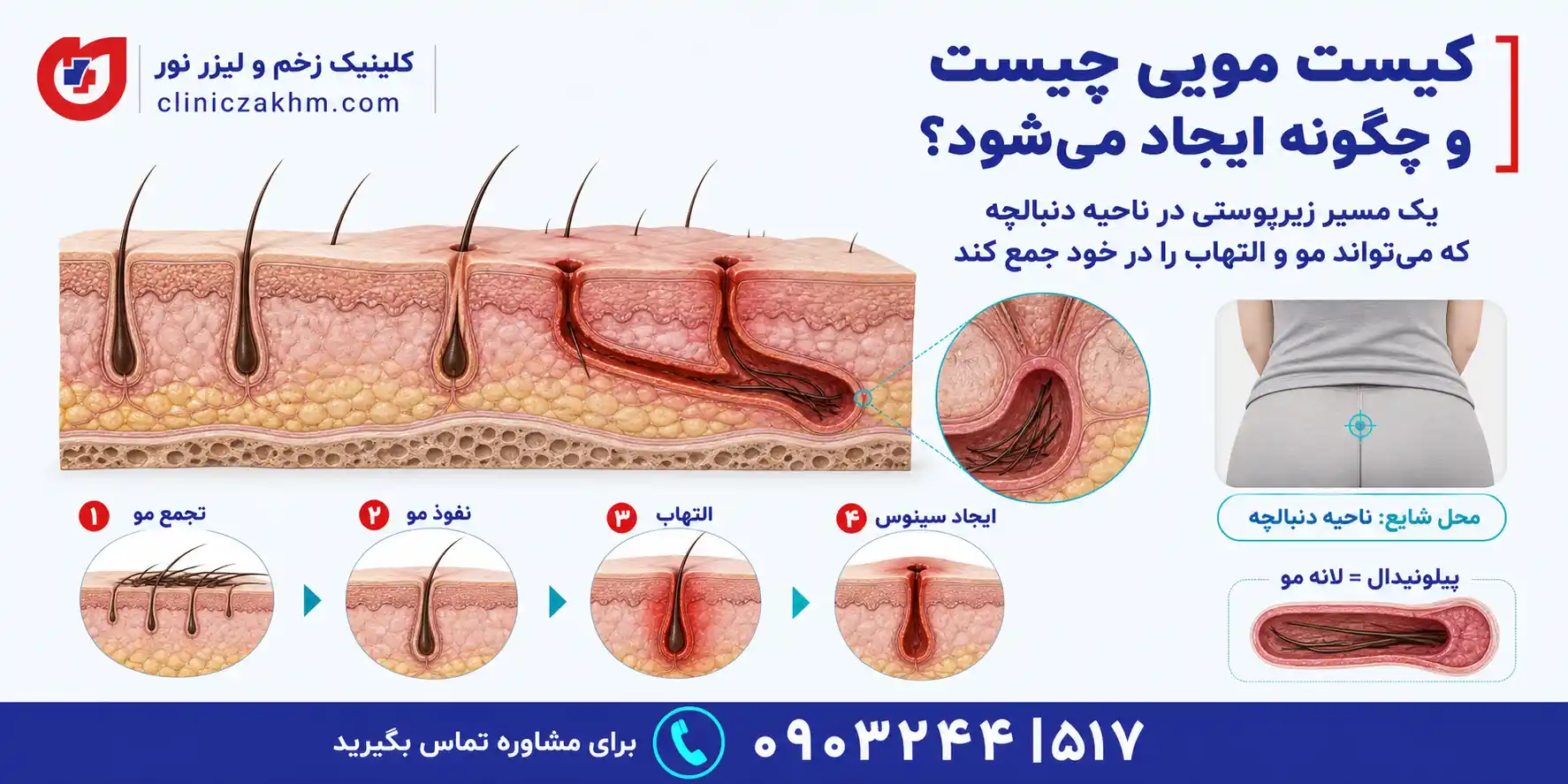 کیست مویی چیست و چگونه در زیر پوست ایجاد می شود