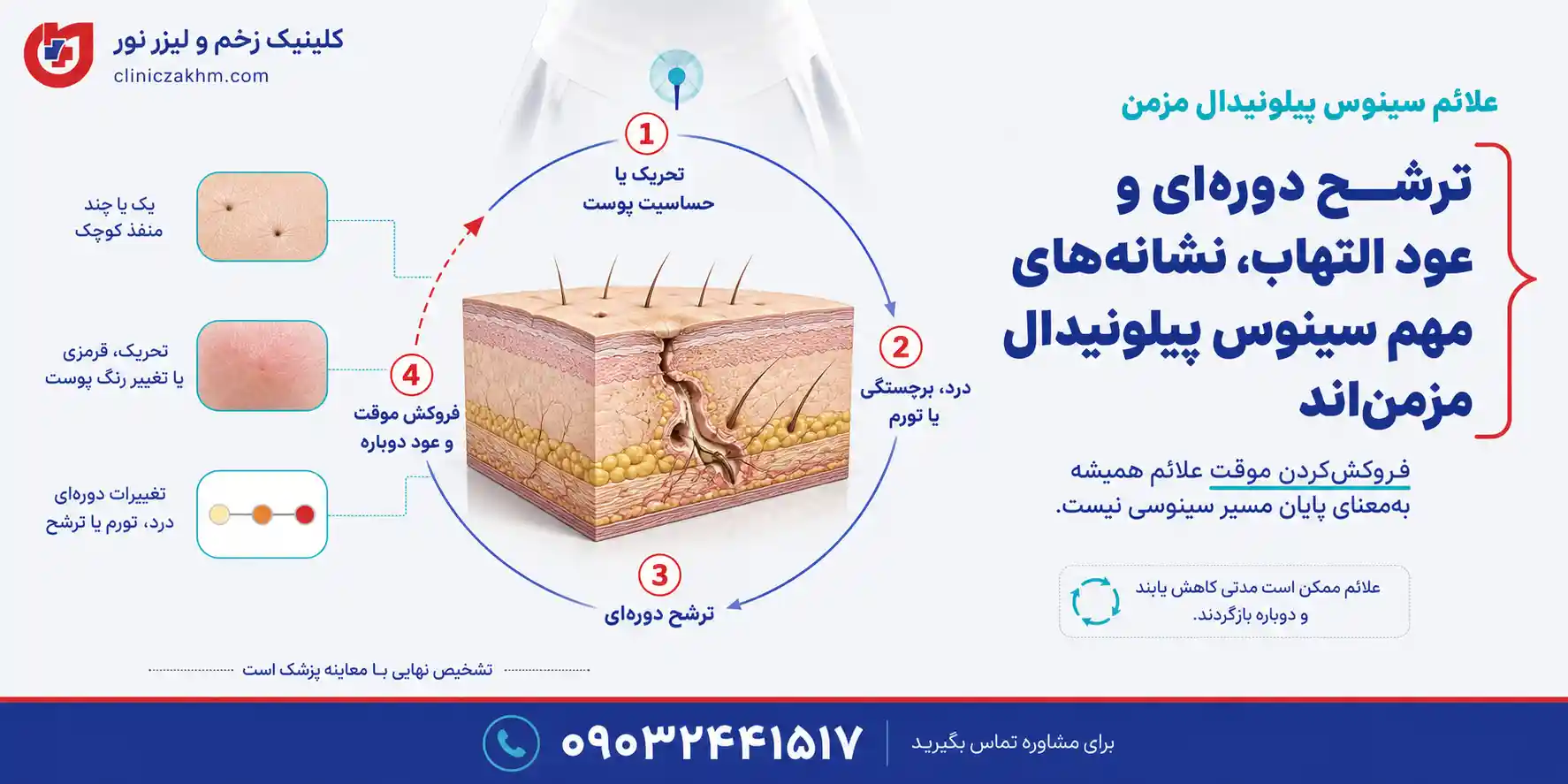 علائم و نشانه‌های سینوس پیلونیدال مزمن