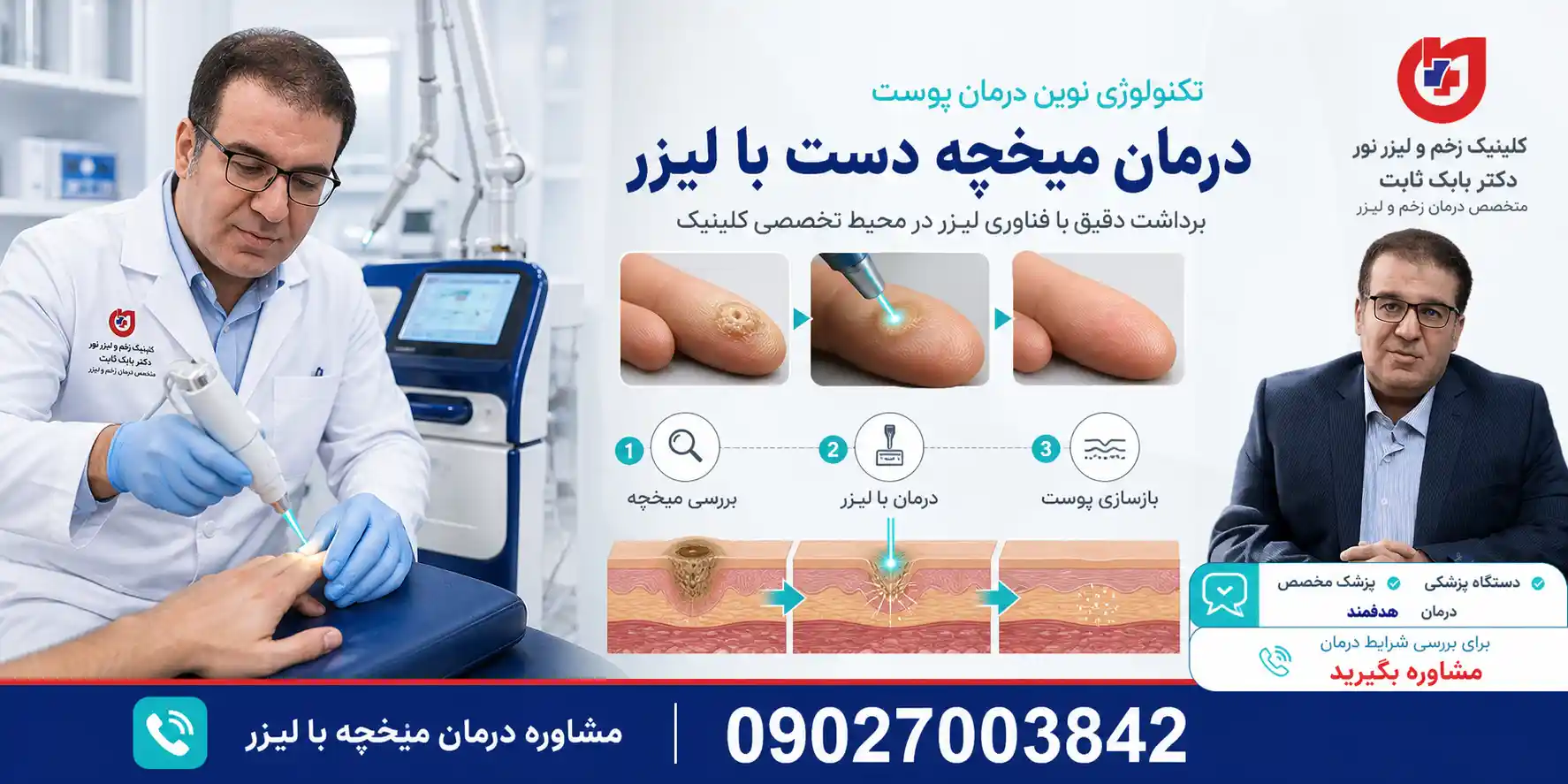 درمان میخچه دست با لیزر