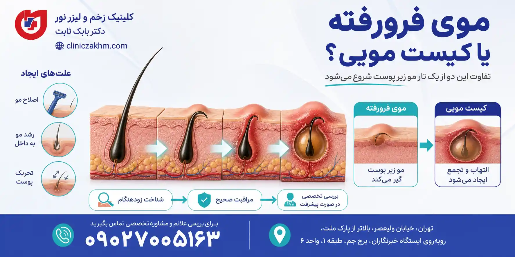 تفاوت موی فرورفته و کیست مویی